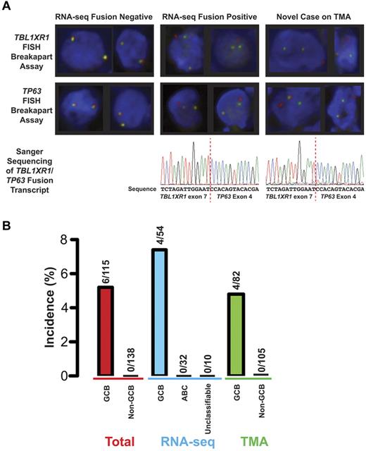 Figure 2. Incidence of the TBL1XR1/TP63 fusion in DLBCL. (A) FISH and Sanger sequencing of the fusion in 3 cases of DLBCL. Left hand column: results from a case known to be negative for the fusion on analysis of RNA-seq data. Middle column: results from a case where the fusion was detected in RNA-seq data. Right hand column: results of a patient who was not part of the RNA-seq cohort. Top panels: examples of representative cells from breakapart FISH assays on TMA. These images were produced at room temperature using an Olympus BX61 microscope with a UPlanFL N 40×/0.75 objective. The fluorochromes are Spectrum green and Spectrum orange. The images were acquired using a CV-M4+CL camera (JAI) and ARIOL software (Version 3.4; Genetix). Bottom panel: electropherograms from Sanger sequencing of an amplicon that spans the junction between TBL1XR1 and TP63 in the gene fusion transcript. (B) Incidence of the TBL1XR1/TP63 fusion in the total cohort and the cohorts where the 2 detection techniques for the fusion were applied. The nonadditive nature of the cohorts toward the total is the result of an overlap of 30 DLBCLs between the 2 cohorts, including 2 DLBCLs that harbor the fusion. Cell of origin designations are as follows: total GCB, 56 by gene expression profiling and 59 by the tally algorithm; total non-GCB, 38 ABC and 14 unclassifiable by gene expression profiling and 86 non-GCB by the tally algorithm; RNA-seq, GCB, ABC, and unclassifiable are all by gene expression profiling; TMA GCB, 23 by gene expression profiling and 59 by the tally algorithm; and TMA non-GCB, 12 ABC and 7 unclassifiable by gene expression and 86 non-GCB by the tally algorithm.
