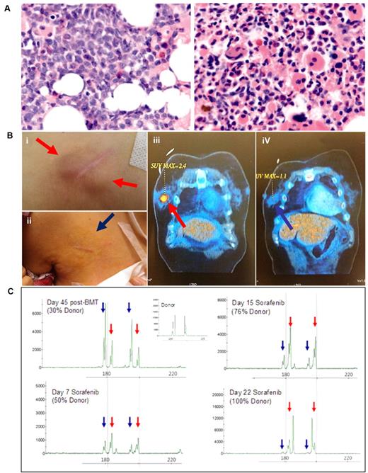 Figure 1. Clinical response to sorafenib. (A) BM biopsy of patient AML1, showing predominance of blasts before sorafenib treatment (left), and return of normal hematopoietic activity after treatment at nCRi (right). Nikon Eclipse E800M; eyepiece 10×; objective 40×; numerical aperture of objective lens 0.95; camera Nikon DS cooled camera head DS-5MC & DC camera control unit DS-L2: magnification of picture 400×; software for imaging processing; Adobe Photoshop CS5 Extended Version 12.0.4x32. Similar responses were seen in another 11 patients (supplemental Figure 1; original magnification ×400). (B) MS at the central line entrance site in patient AML1 before sorafenib (i) completely resolved after sorafenib treatment for 3 weeks (ii). In patient AML13, a left breast MS (iii) also completely resolved after sorafenib treatment for 3 weeks (iv). (C) Donor and recipient DNA chimerism for patient AML3 who relapsed after HSCT. Red arrows indicated donor and blue arrows recipient specific allele peaks. A progressive decrease of recipient and a corresponding increase in donor DNA chimerism accompanied clinical responses to sorafenib treatment.