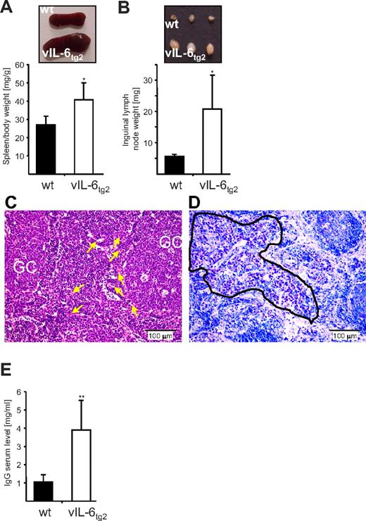 Figure 2. vIL-6 mice display characteristics of plasma-cell type MCD, including splenomegaly, lymphadenopathy, lymph node vascular proliferation and plasmacytosis, and hypergammaglobulinemia. (A) Splenomegaly in vIL-6tg2 mice. Top panel: Photograph of a representative wild-type and vIL-6tg2 mouse spleen. Bottom panel: Average ratio of spleen to body weight determined from 15-week-old wild-type (n = 7) and vIL-6tg2 (n = 10) mice. (B) Lymphadenopathy in vIL-6tg2 mice. Top panel: Photographs of PLNs from 3 independent wild-type and vIL-6tg2 mice. Bottom panel: Averaged weights of inguinal lymph nodes from 15-week-old wild-type (n = 7) and vIL-6tg2 (n = 10) mice (based on the sum of the weight of both nodes per mouse). (C) H&E-stained lymph node of a representative vIL-6tg2 mouse demonstrating interfollicular vascular proliferation (20-fold magnification). Blood vessels are marked by arrows. (D) Giemsa staining from the same vIL-6tg2 lymph node revealing plasmacytosis (20-fold magnification). A cluster of mature plasma cells (encircled) is filling the sinusoids. (E) Hypergammaglobulinemia in vIL-6tg2 mice. Average relative serum IgG levels are shown from 15-week-old wild-type (n = 7) and vIL-6tg2 (n = 10) mice, as measured by ELISA. Error bars represent SD. *P ≤ .01. **P ≤ .001.