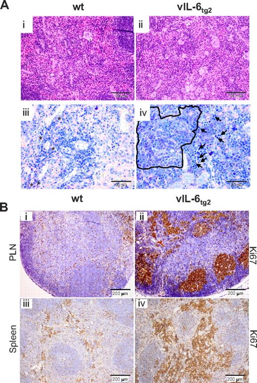 Figure 3. vIL-6tg2 mice exhibit increased splenic extramedullary hematopoiesis and plasmacytosis, and increased cell proliferation in lymph nodes and spleen. (A) Representative hematoxylin and eosin-stained sections of spleen from 21-week-old wt (Ai) and vIL-6tg2 (Aii) mice, showing an increased number of megakaryocytes and granulocytes in vIL-6tg2 only (20-fold magnification). (Aiii-iv) Giemsa staining of serial sections from the same spleen shown in subpanels i and ii at 40-fold magnification. vIL-6tg2 display a cluster of mature plasma cells (encircled) and several foci of erythropoiesis as marked by arrows (iv) that are not observed in wt (iii). (B) Ki67 staining of PLNs (Bi-ii) and spleen (Biii-iv) of a 15-week-old wild-type (i,iii) and vIL-6tg2 (ii,iv; 10-fold magnifications). Increased proliferation was observed in hyperplastic germinal centers of lymph nodes from transgenic mice (ii). vIL-6tg2 spleen tissue (iv) showed increased proliferation in the red pulp of vIL-6tg2 spleen, indicating hematopoiesis. Representative images are shown.