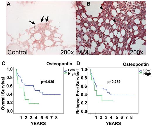 Figure 1. OPN protein expression by IHC and survival. OPN expression in control BM (A) and AML (FAB AML M5; B) obtained at presentation. IHC localization was performed using the respective specific Abs and the alkaline phosphatase/antialkaline phosphatase technique. Note the expression of OPN in the BM sections of AML patients (B arrowhead) compared with the controls (A arrow). Original magnification, 200×. Images were captured with Axiocam (Zeiss) using Axiovision (Zeiss) and Image-Pro Plus (Media Cybernetics). Kaplan-Meier curves of OS and relapse-free survival for AML patients stratified for BM OPN expression are shown. OS of patients expressing high levels of OPN (≥ 9.662 AUs) in the BM was significantly lower than of patients with low OPN expression (< 9.662 AUs; P = .025; C). Although a visible trend, the difference found for relapse-free survival was not significant (P = .279; D).