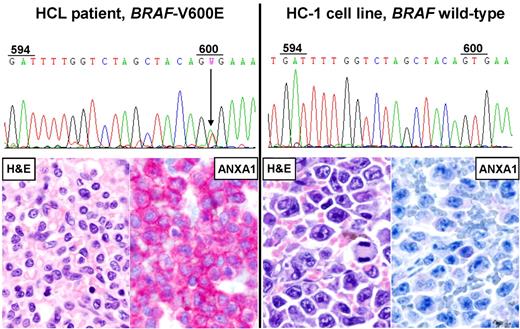 Figure 1. Human cell lines of putative HCL origin lack the BRAF-V600E mutation and key phenotypic features of HCL. Direct DNA Sanger sequencing of BRAF-exon154 in the HC-1 cell line (right chromatogram) shows the absence of the T-to-A point mutation at codon 600 leading to the V600E amino acid replacement, which is instead present heterozygously in primary leukemic cells MACS-purified from the peripheral blood of an HCL patient (left chromatogram). Both HC-1 cells and patient's leukemic cells display a wild-type codon 594 (GAT), as opposed to HAIR-M cells harboring a clonal heterozygous T-to-A point mutation at this codon (not shown) that leads to the D594E amino acid replacement. HC-1 cells xenografted in an NSG mouse show diffuse infiltration of the spleen by large B-cell lymphoma-like cells (right H&E staining) that are negative for annexin-1 (ANXA1; right ANXA1 immunostaining1). Conversely, the splenectomy specimen of the HCL patient is infiltrated by small mature-looking lymphoid cells with wide pale cytoplasm (left H&E staining) strongly expressing annexin-1 (left ANXA1-staining). All micrographs were collected using an Olympus B61 microscope (equipped with an Olympus UPlanApo 40×/0.8 NA objective and with an Olympus E330-ADU1.2x camera) and were acquired and processed using Olympus cell∧B imaging software.