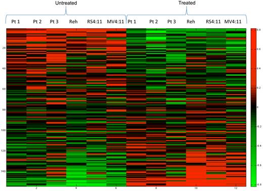 Figure 1. Gene expression microarrays in primary B-lymphoblastic leukemia patient samples and cell lines reveal reversal of relapse-specific signature. Heat map showing the effect of vorinostat in reversing the relapse-specific gene expression profile. Rows represent individual genes (154 probes); relative overexpression is shown in red and underexpression in green. The first 3 columns are primary patient samples (1, 2, and 3), followed by the Reh, RS4:11, and MV4:11 cell lines, respectively, before treatment with vorinostat; the next 6 columns correspond to each sample after treatment.
