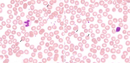 A 74-year-old white woman with lichen planus and hemoglobin 130g/L was started on 100 mg of dapsone daily. Within 2 weeks she developed progressive fatigue, shortness of breath on exertion, yellowing of her skin, and dark urine. By the time she was assessed and admitted to hospital approximately 4 weeks later, her hemoglobin was 75g/L with elevated LDH, reticulocyte count, and indirect bilirubin. She was otherwise healthy and was not on any other medications. There was no family history of anemia or G6PD deficiency. The antiglobulin test was negative, and a G6PD test was not ordered. The dapsone was discontinued and she received 3 units of red blood cell concentrates. One week later she was seen by hematology. The hemoglobin, reticulocyte count, and indirect bilirubin had returned to normal. The original peripheral blood smear was unavailable but the current smear showed “bite” cells (see arrows in figure). The direct antiglobulin test remained negative and Heinz bodies were not seen on supravital stains. The patient did not return for further assessment and G6PD testing. / Dapsone is an antibacterial agent used for infections such as Mycobacterium tuberulosis. It has anti-inflammatory and immunomodulatory properties that may be useful in various skin diseases such as lichen planus. Dapsone metabolites can lead to oxidative stress, denatured hemoglobin, and methemoglobinuria. Occasionally, “bite” cells can be seen on peripheral smears. Patients receiving dapsone should be assessed for evidence of hemolysis.