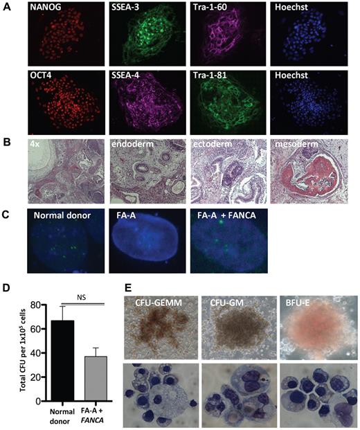 Figure 4. Derivation and hematopoietic differentiation of patient-specific FA iPSCs. (A) Immunofluorescence of complemented patient-derived FA-A iPSCs. (B) Representative H&E stains of teratomas obtained by intramuscular injection of a complemented FA-A iPSC clone (4× and 20× magnification). (C) FANCD2 foci formation of normal donor (ND) or patient-specific complemented FA iPSC lines after exposure to vehicle or 2mM HU for 16 hours (60× magnification). (D) Number of CFUs per 1 × 105 normal donor and complemented patient-derived FA-A input cells (n = 3 independent clones, mean ± SD). (E) Photomicrographs depicting CFUs derived from patient-specific FA-A iPSCs and cytology of erythroid precursor cells, macrophages, and granulocytes (20× and 60× magnification). Images were obtained from FA-A iPSCs derived from patient sample number 2. GEMM indicates granulocyte/erythroid/macrophage/megakaryocyte; GM, granulocyte/macrophage; and BFU-E, burst-forming unit-erythroid.