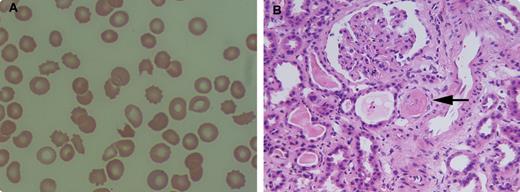 A 59-year-old female who had been diagnosed with multiple myeloma received treatment with bortezomib and dexamethasone. Subsequently, she underwent autologous peripheral stem cell transplantation. Two months later she was admitted with a urinary tract infection complicated by Klebsiella bacteremia. Her complete blood count showed anemia (8.5 g/dL), thrombocytopenia (22 K/uL), increased reticulocytes, and normal white blood cells (8.9 K/uL). The peripheral blood smear (panel A) revealed moderate schistocytosis. The LDH was 2920 IU/L, haptoglobin was undetectable, D-dimer was 2020, fibrinogen was 375, and ADAMTS13 activity was low. / Acute renal failure ensued that required hemodialysis. A kidney biopsy showed thrombotic microangiopathic nephropathy (panel B; arrow shows a thrombus). A diagnosis of thrombotic thrombocytopenic purpura (TTP) was made and plasmapheresis was started with resolution of TTP over the next few weeks. Although schistocytes are a clue to disseminated intravascular coagulopathy, malignancy, anatomic vascular abnormalities, hypertension, and connective tissue disease among others, they were indicative of TTP in this patient.