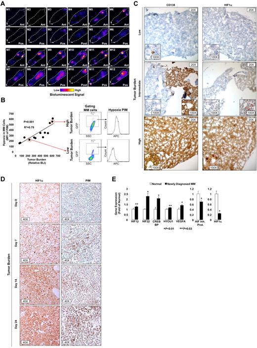 Figure 1. Tumor progression increases hypoxia in MM cells in vivo. (A) Representative BLIs of 12 SCID mice with different levels of tumor burden after injection of MM1s-GFP-Luc cells. (B) Correlation between tumor burden as detected by BLI and hypoxia in MM cells shown as the MFI of allophycocyanin-PIM in the MM cells (GFP+). (C) IHC images of specimens taken from the femurs of mice injected with MM1s-GFP-Luc with different levels of BLI stained with Abs for CD138 and HIF1α. Red arrows show nuclear staining with HIF1α. (D) IHC images of specimens taken from mice at different time points after the injection of 5T33MM mouse cells stained with Abs for PIM and HIF1α showing that binding of PIM and expression of HIF1α were directly correlated with tumor burden. (E) Gene-expression analysis of hypoxia-induced genes (including HIF1β, HIF2β, CREBBP, HYOU1, and VEGF1) in plasma cells isolated from normal subjects and MM patients using published datasets from the Gene Expression Omnibus by Chng et al (series number GSE 647726).