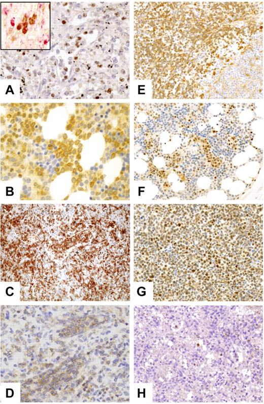 Figure 3. Validation of genes overexpressed in GEP by immunohistochemistry. Representative HSTL disclosed staining of neoplastic cells for FOSB (A), SYK (B), CD56 (C), BCL10 (D), GSTP1 (E), and PRDM1 (F-G). Panel G shows DERL2 cells. The inset of panel A illustrates FOSB-positive cells (brown) also expressing TIA1 (red). Staining of scattered reactive cells positive for granzyme H is seen (H). Images were captured with a Zeiss Axioskop2 microscope (Zeiss). Photographs were taken with an Olympus DP70 camera. Images were acquired with Olympus DP Controller 2002 and images were processed with Adobe Photoshop Version 7.0. Original magnification, 400× (A-H).