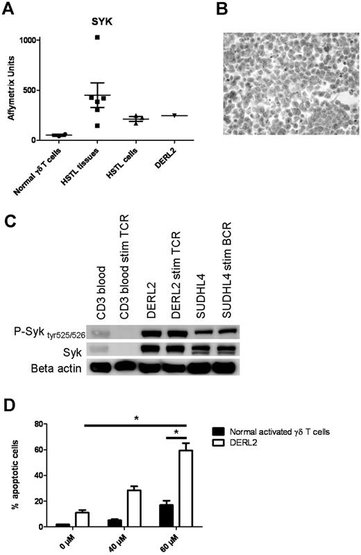 Figure 6. SYK is a potential candidate target for pharmacologic inhibition. (A) Histogram representation of Affymetrix data of overexpressed SYK probe set in HSTL tissues, HSTL cells, normal γδ T cells, and DERL2 cells. (B) Immunostaining of SYK in the DERL2 cell line. (C) Western blot analysis of Syk, phosphorylated Syk tyr525/526, and loading control β actin. (D) DERL2 cells or normal activated γδ T cells were cultured with 40 or 60μM Syk inhibitor II or vehicle alone for 48 hours. Apoptosis was analyzed using 7AAD staining. For normal activated γδ T cells, TCRVγ9 apoptotic cells were determined by measuring the percentage of TCRVγ9+ and 7AAD+ cells. *P < .05.