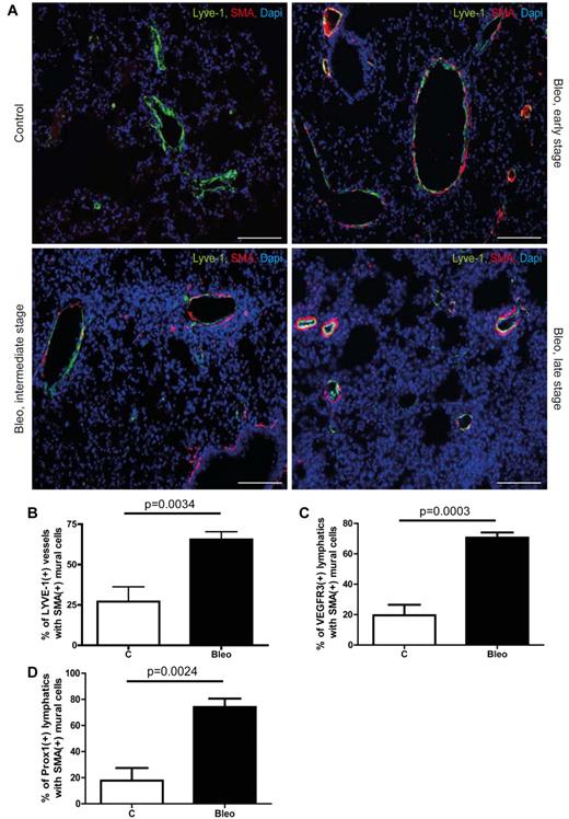 Figure 1. Aberrant recruitment of mural cells to lymphatic vessels during pulmonary fibrosis. (A) Immunodetection of mural cells (SMA) and Lyve-1–positive vessels in fibrotic lungs of mice treated with bleomycin (Bleo; 10 mg/kg body weight twice a week intraperitoneally) and in healthy controls of mice treated with PBS (100 μL twice a week intraperitoneally) at day 28. Fibrosis is shown at early, intermediate, and late stage. Scale bars equal 100 μm. (B) Quantitative analysis of Lyve-1–positive vessels with SMA-positive mural cells in lung tissue of bleomycin-injected and healthy control mice at day 28 (controls n = 6; Bleo n = 8). (C) Quantitative analysis of VEGFR3-positive lymphatic vessels with SMA-positive mural cells in lung tissue of bleomycin-injected and healthy control mice at day 28 (controls n = 5; Bleo n = 5). (D) Quantitative analysis of Prox1-positive lymphatic vessels with SMA-positive mural cells in lung tissue of bleomycin-injected and healthy control mice at day 28 (controls n = 5; Bleo n = 5). Error bars show SEM.