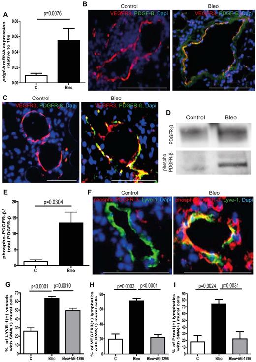 Figure 2. Ectopic expression of PDGF-B in lymphatic vessels and phosphorylation of PDGFR-β in mural cells leads to aberrant mural cell recruitment during pulmonary fibrosis. (A) Quantitative analysis of the PDGFR-β expression in isolated lymphatic endothelial cells of bleomycin-treated (Bleo) and healthy control mice at day 28 (controls n = 15; Bleo n = 14). Immunostaining of PDGF-B (B) or PDGFR-β (C) and lymphatic vessels (VEGFR3) on lung tissue of fibrotic and control mice at day 28. Scale bars equal 100 μm. (D) Westernblot of phospho–PDGFR-β and total PDGFR-β of whole lung lysates at day 28 after treatment with bleomycin or PBS, respectively (controls n = 5; Bleo n = 13). (E) Quantitative analysis of the ratio of phospho–PDGFR-β to total PDGFR-β at day 28 after treatment with bleomycin or PBS (controls n = 5, Bleo n = 13). (F) Double-immunodetection of phospho–PDGFR-β and lymphatic vessels (VEGFR3) on healthy and fibrotic murine lung tissue at day 28. Scale bars equal 100 μm. Quantitative analysis of Lyve-1–positive lymphatic vessels (G), VEGFR3-positive lymphatic vessels (H) or Prox1-positive lymphatic vessels (I) covered with SMA-positive mural cells at day 28 after treatment with bleomycin, bleomycin + AG-1296 (Bleo + AG-1296; 10 mg/kg body weight twice a week intraperitoneally; 0.5 ng, 5 times per week intraperitoneally, starting at day 14 after first bleomycin injection) or in healthy control lungs of PBS-treated mice (controls n = 15; Bleo n = 29, Bleo + AG-1296, n = 13). Error bars show SEM.