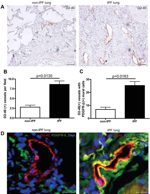 Figure 6. Aberrant mural cell recruitment in human IPF lungs. (A) Immunohistochemistry of lymphatic vessels with the marker D2-40 on on-IPF lung tissue and IPF samples. Scale bars equal 200 μm. (B) Quantitative analysis of D2-40–positive vessels in lung tissue of IPF- and non-IPF patients (non-IPF n = 3, IPF n = 12). (C) Quantitative analysis of D2-40–positive lymphatic vessels associated with PDGFR-β–positive mural cells in lung tissue of IPF- and non-IPF–patients (non-IPF n = 3, IPF n = 12). (D) Simultaneous immunodetection of lymphatic vessels and pericytes, with the markers D2-40 and PDGFR-β, on non-IPF lung tissue and IPF samples. Scale bars equal 50 μm. Error bars show SEM.
