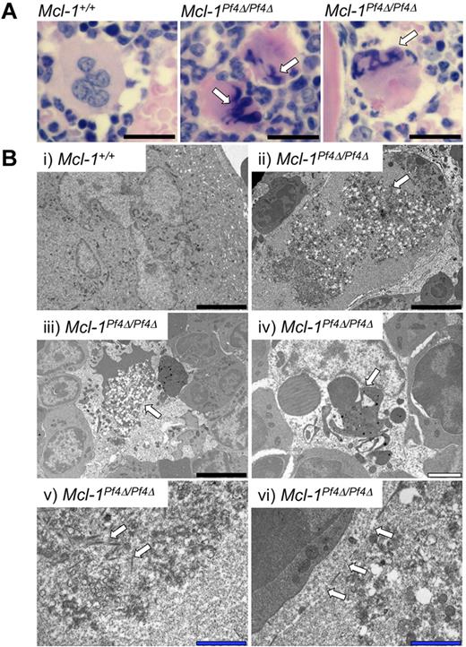 Figure 3. Apoptosis of Mcl-1–deficient megakaryocytes in vivo. (A) H&E-stained sternum sections from ABT-737–treated Mcl-1+/+ and Mcl-1Pf4Δ/Pf4Δ mice, 2.5 hours after treatment. Pyknotic nuclei are indicated by white arrows. Scale bar: 20 μm. (Bii-vi) Representative transmission electron microscope images of BM sections showing aberrant megakaryocyte morphology and death in Mcl-1Pf4Δ/Pf4Δ mice 2.5 hours after ABT-737 treatment. White arrows highlight abnormal characteristics in Mcl-1Pf4Δ/Pf4Δ megakaryocytes not observed in wild-type controls (i). (i-iii) Examples of megakaryocytes displaying cytoplasmic vacuolization. (iv) Dysmorphic megakaryocyte nucleus. (v) Accumulation of short filamentous bundles within megakaryocyte. (vi) Megakaryocyte displaying fragmentation of plasma membrane. Black scale bars: 5 μm; white scale bar: 2 μm; blue scale bar: 1 μm.