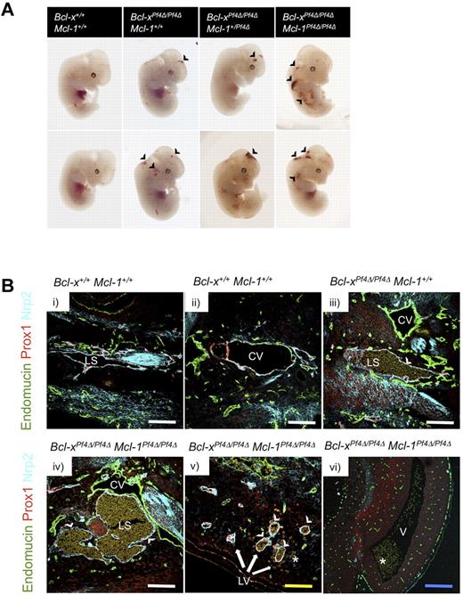Figure 5. Bcl-xPf4Δ/Pf4Δ Mcl-1Pf4Δ/Pf4Δ embryos exhibit hemorrhages and blood-filled lymphatic vessels. (A) Representative images from E12.5 wild-type, Bcl-xPf4Δ/Pf4Δ Mcl-1+/+, Bcl-xPf4Δ/Pf4Δ Mcl-1+/Pf4Δ, and Bcl-xPf4Δ/Pf4Δ Mcl-1Pf4Δ/Pf4Δ embryos. Black arrowhead indicates areas of ectopic bleeding. Note, some embryos have been tailed for genotyping. (B) Immunofluorescent detection of blood vessels and lymphatic vessels using Abs directed against endomucin (green), Prox1 (red), and neuropilin2 (Nrp2; cyan). Blood-filled lymph sacs (iii-iv) and lymphatic vessels (v) are a feature of E12.5 Bcl-xPf4Δ/Pf4Δ Mcl-1+/+ and Bcl-xPf4Δ/Pf4Δ Mcl-1Pf4Δ/Pf4Δ, but not wild-type (i-ii) embryos. (vi)Hemorrhages were also observed in Bcl-xPf4Δ/Pf4Δ Mcl-1Pf4Δ/Pf4Δ embryos. Z-stack images were obtained using a Bio-Rad Radiance 2100 confocal microscope equipped with 3 lasers (488-nm Argon-ion laser, HeNe 543-nm green laser, 637-nm red diode laser) attached to an Olympus IX70 inverted microscope with UPlanApo 10×/0.40 ∞/0.17 and UApo/340 20×/0.70W ∞/0.17 objectives. Image acquisition was performed at room temperature using LaserSharp 2000 software (Version 5.2; Bio-Rad Laboratories). Adobe Photoshop CS5 (Version 12.0; Adobe) was used for subsequent image processing. LS indicates lymph sac; CV, cardinal vein; LV, lymphatic vessels; and V, ventricle. White arrowheads indicate blood-filled lymph sacs/lymphatic vessels and white asterisks (*) indicate areas of hemorrhage. Scale bars: 120 μm (white), 80 μm (yellow), and 240 μm (blue).