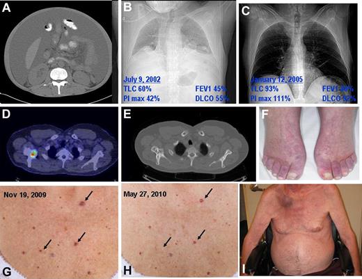 Figure 2. Classic findings of POEMS syndromes. (A) Massive ascites and lipodystrophy. (B) Chest radiograph and pulmonary function test results demonstrating reduced lung volumes because of neuromuscular weakness, small effusions, and reduced diffusing capacity of carbon monoxide. (C) Improved chest radiograph and pulmonary function tests 2.5 years after ASCT (same patient as in panel H). (D) Fusion CT PET of mixed lytic/sclerotic lesion in right scapula. (E) Bone windows of CT of mixed lytic/sclerotic lesion in right scapula. (F) Hyperemia of extremities and white nails. (G) Outcropping of cherry angiomata at diagnosis. (H) Shrinkage and disappearance of cherry angiomata after radiation to solitary osteosclerotic lesion in right femur. (I) Plasmacytoma right scapula with overlying erythema as well as gynecomastia, muscle wasting, and ascites. Also present but unrelated is florid tinea corpis resulting from chronic steroid used for the incorrect diagnosis of CIDP.