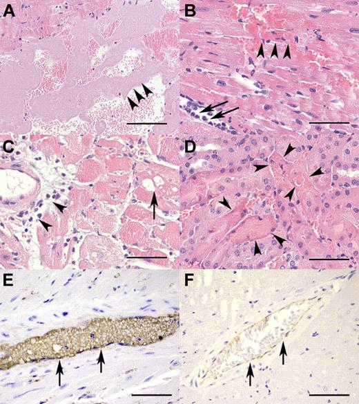 Figure 2. TTP-like pathohistologic changes in rhVWF-challenged animals. (A) The presence of large aggregates of platelets (arrowheads) within the left ventricle 30 minutes after TTP induction (H&E, original magnification ×100). Bar represents 200 μm. (B) Myocardial necrosis and hemorrhage (arrowheads) as well as rolling and extravasation of neutrophilic granulocytes (arrows) within the first 3 hours of TTP induction (H&E, original magnification ×400). Bar represents 50 μm. (C) Vacuolation of myocytes (arrow) and perivascular infiltration of neutrophilic granulocytes (arrowheads) within 24 hours after TTP induction (H&E, original magnification ×200). Bar represents 100 μm. (D) Renal tubular necrosis (arrowheads) characterized by loss of cellular detail, increased eosinophilia of cytoplasm, and karyopyknosis within 24 hours after TTP induction (H&E, original magnification ×400). Bar represents 50 μm. (E) Myocardial artery (arrows) immunohistochemically strongly positive for VWF 60 minutes after TTP induction (VWF immunohistochemistry, original magnification ×600). Bar represents 33 μm. (F) Myocardial artery (arrows) of an untreated control animal with minor background staining for VWF resulting from cross-reactivity of the antibody with endogenous murine VWF (VWF immunohistochemistry, original magnification ×200). Bar represents 100 μm.