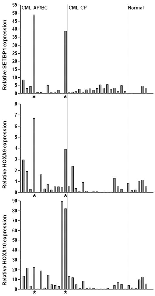 Figure 7. SETBP1 activation is involved in human CML progression. Real-time RT-PCR analysis of SETBP1, HOXA9, and HOXA10 mRNA levels in total RNA isolated from whole BM of healthy volunteers (normal) and CML chronic phase (CML CP) and advanced/blast crisis phase (CML AP/BC) patients (*samples expressing high SETBP1 mRNA levels). Relative expression levels were calculated by normalizing to BCR mRNA levels in the same sample.