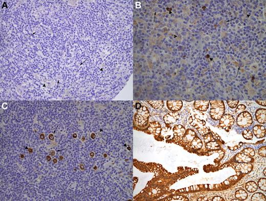 Figure 1. Uniform criteria for evaluation of RS COX-2 staining. Representative immunohistochemistry cases from the tissue microarrays of negative RS COX-2 staining (A), low positive RS COX-2 staining (B), or high positive RS COX-2 staining (C). All cases are presented at a 40× magnification. Thin arrows indicate RS cells; arrowheads, histiocytes; thick arrows, plasma cells. Colon mucosa was used as a positive control for COX-2 expression (D).