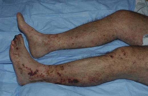 Purpura and distal infarction in a patient with cryoglobulinemia.