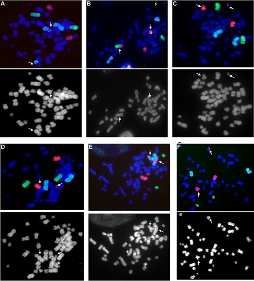 Figure 1. Representative images of radiation-induced chromosomal aberrations. Metaphase spreads hybridized with probes specific for chromosomes 1 (DEAC/blue), 5 (FITC/green), and 11 (Texas Red/red) and chromosomes 3 (DEAC), 7 (FITC), and 21 (Texas Red). Corresponding black-and-white images are also shown (original magnification ×630). (A) Chromosome 1 is involved in a reciprocal translocation (t) with an unpainted chromosome. (B) Chromosome 5 is involved in a dicentric with chromosome 11 accompanied by a dual-color fragment. (C) Break in chromosome 11 resulting in 2 parts: 1 with a centromere (centric fragment) and 1 without a centromere (acentric fragment). (D) Chromosome 11 is involved in a dicentric with an unpainted chromosome accompanied by a fragment. (E) Multiple abnormalities, including insertion of portion of chromosome 7 into chromosome 3 accompanied by dual-color fragment. (F) Chromosome 7 is involved in a terminal translocation with an unpainted chromosome.