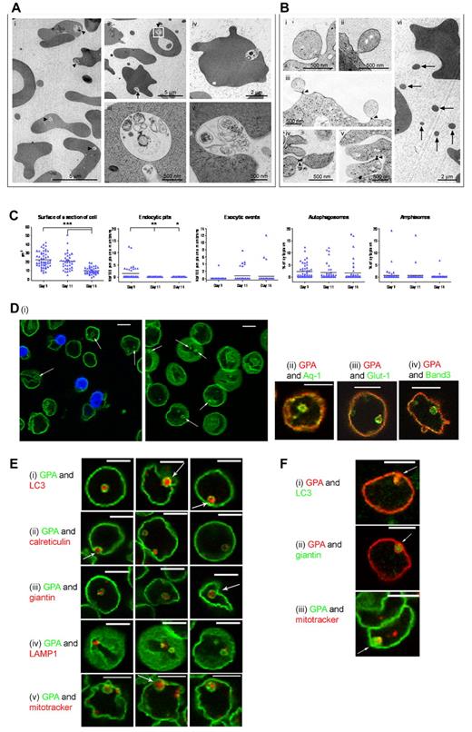 Figure 5. TEM of cytoplasmic and membrane remodeling in erythroblasts and reticulocytes and detection of GPA-positive vesicles by confocal microscopy. (A) Representative TEM images of day 23 filtered reticulocytes containing large autophagic compartments (autophagosomes and amphisomes). (i-ii) Fields of R2 reticulocytes, some retaining large autophagic vacuoles (arrowheads) containing poorly degraded organelles; identical compartments were also observed undergoing exocytosis (arrow). (iii) Higher magnification image of the autophagic vacuole outlined in panel ii. (iv-v) Examples of exocytic events in reticulocytes. (B) Evidence for plasma membrane blebbing during human in vitro erythropoiesis. (i-ii) Plasma membrane blebs on the surface of erythroblasts. (iii-v) Plasma membrane blebs showing electron-dense constrictions at their bases (arrowheads). (vi) Example field of a reticulocyte culture containing cellular fragments (arrows) of comparable size to the plasma membrane blebs observed in erythroblasts. (C) Analysis of reticulocytes isolated after 7 days in final stage medium and analyzed at days 7, 11, and 14 (numbers of cells analyzed: 54 at day 7, 37 at day 11, and 43 at day 14). Black bars represent the mean. *P ≤ .05; **P ≤ .01; ***P ≤ .001. (D) GPA-stained cells before and after filtration (left and right panels, respectively) show the presence of vesicles (arrows; i). (ii-iv) GPA (red) dual-stained aquaporin-1 (Aq-1), Glut-1, and band 3 (all green), respectively. (E) Filtered reticulocytes were dual stained with GPA (green) and Abs to organelle markers (red) for autophagy (LC3; i), ER (calreticulin; ii), Golgi (giantin; iii), lysosomes (LAMP1; iv), and mitochondria (MitoTracker; v). Arrows highlight vesicles fusing with the plasma membrane. All cells were cultured following protocol A. (F) Presence of GPA-positive vesicles in vivo. GPA-positive vesicles (red) containing organelle markers (green) for autophagy (LC3; i) and Golgi (giantin; ii) and GPA-positive vesicles (green) with mitochondrial probe MitoTracker (red) found in cells from peripheral blood (iii). Arrows highlight colocalization. Scale bars indicate 5 μm.