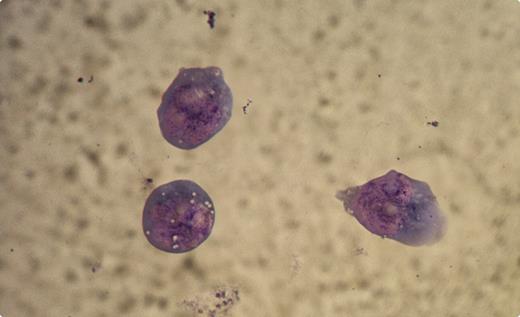A 76-year-old woman presented with diffuse large B-cell non-Hodgkin lymphoma (NHL), stage III A, low-intermediate International Prognostic Index. The disease involved the retroperitoneum, laterocervical, and supraclavicular regions. Bone marrow and other organ sites were negative. She received 5 of 6 planned cycles with rituximab, cyclophosphamide, doxorubicin, vincristine, and prednisone. One month after the fifth cycle, while in complete remission, she developed flaccid quadriplegia along with left hemiparesis, gaze palsy, dysphonia, and dysphagia. The clinical picture was suggestive of Guillain-Barrè syndrome but there was no response to high-dose intravenous immunoglobulins. Brain CT showed diffuse meningeal enhancement. The cerebrospinal fluid showed mononucleated cells 12 000/mm3, protein 151 mg/dL, and glucose 5 mg/dL. Microscopic examination of the fluid showed large mononucleated cells with multiple prominent nucleoli (see figure). The cells were positive for CD19 and CD20, as were the original malignant B cells. / A diagnosis of leptomeningeal lymphoma was made. After intrathecal chemotherapy with methotrexate, cytosine arabinoside, and dexamethasone, she showed improvement but died of bacterial sepsis. This case illustrates an example of meningeal lymphoma arising in a patient with NHL in presumed complete remission. The neurologic abnormalities and abnormal cerebrospinal fluid and the microscopic appearance of lymphoma cells established the diagnosis.