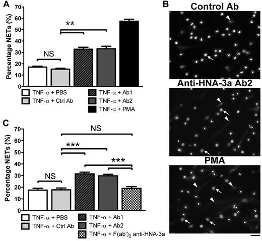 Figure 1. Effect of anti–HNA-3a antibody on NET formation by human neutrophils. (A) Quantification of NETs after anti–HNA-3a antibody treatment by fluorescence microscopy analysis. HNA-3a-positive neutrophils primed with TNF-α were incubated for 180 minutes with PBS (TNF-α + PBS), control IgG purified from healthy volunteer plasma (TNF-α + Ctrl Ab), anti–HNA-3a antibody purified from 2 donors whose plasma induced TRALI (TNF-α + Ab1 and TNF-α + Ab2), or 25nM PMA as a positive control (TNF-α + PMA). DNA release was visualized after DNA staining with Hoechst 33342. The experiment was independently performed 9 times. Bars represent mean ± SEM. **P < .01. (B) Examples of the fluorescence images quantified in panel A. White arrowheads indicate selected cells forming NETs; and white arrows, examples of delobulated (large) neutrophil nuclei. Their presence indicates nuclear decondensation, an early step in NETosis. Scale bar represents 50 μm. (C) Quantification of NETs after anti–HNA-3a F(ab′)2 fragment treatment by fluorescence microscopy analysis. HNA-3a–positive neutrophils were incubated and analyzed in the same conditions as in panel A but were also treated with anti–HNA-3a F(ab′)2 fragments (TNF-α + F(ab′)2 anti–HNA-3a). The experiment was independently performed 3 times. Bars represent means ± SEM. ***P < .005. NS indicates not significant.