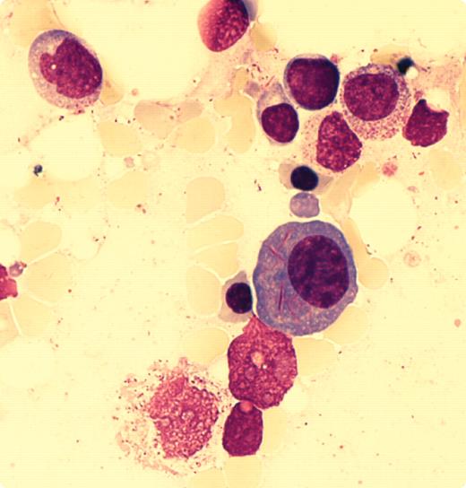 An 83-year-old woman with chronic gastrointestinal problems developed retinal vein thrombosis. Laboratory tests revealed an erythrocyte sedimentation rate of 45, renal dysfunction (GFR 25 mL/min), and mild anemia (hemoglobin 10 G/dL) with normal white cells and platelets. β2-microglobulin was elevated at 8.06 mg/L. A plasma cell dyscrasia was suspected and immunoglobulin testing showed monoclonal IgG, κ in the serum (28.9 g/L) with free κ chains (1.2 g/L), and κ light chains in the urine (10.2 g/L). Bone marrow aspirate contained ∼ 10% plasma cells (CD38+CD138+) with long, slender, Auer-like inclusions (see figure) in 50% of the cells. Approximately 14% of the plasma cells had multinuclear forms. / Auer-like inclusions raise the possibility of acute nonlymphocytic leukemia (ANNL). However, the patient has been followed since the previous year with no evidence of ANNL. Rare instances of Auer-like inclusions within plasma cells have been previously reported. The mechanism by which they occur and their pathophysiologic significance are not understood. Continued observations on this patient may provide more information on the unusual occurrence of Auer rods in a patient with monoclonal gammopathy.