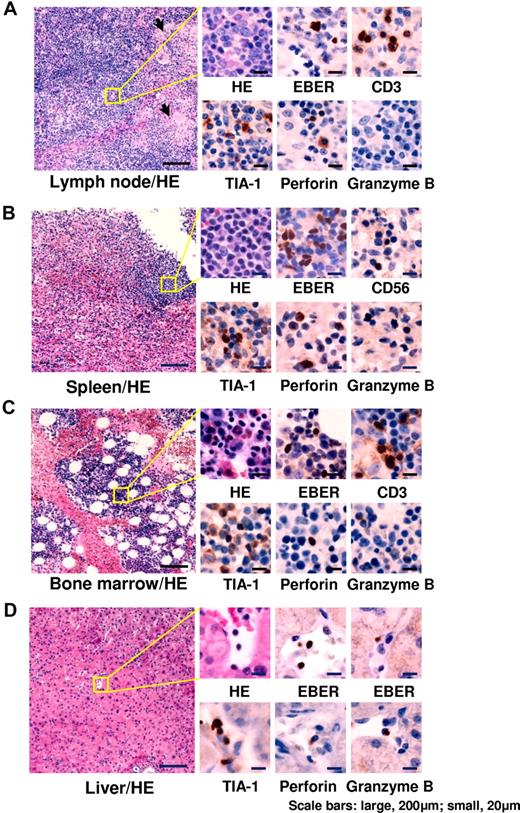 Figure 2. Histopathological findings of representative patients. (A) Cervical lymph node from a 6-year-old boy with chronic active EBV disease with T-cell infection (patient 3). Follicles and paracortical hyperplasia including a mild increase in transformed lymphocytes were seen. Focal epithelioid reactions were detected (arrows). Medium-sized transformed lymphocytes in the paracortex were positive for EBER. TIA-1 and perforin were positive, but granzyme B was negative. (B) Spleen from a 13-year-old boy with chronic active EBV disease with NK-cell infection (patient 6). White pulp was atrophic and red pulp showed congestion. Small lymphocytes infiltrating in the red pulp were positive for EBER. TIA-1 and perforin were positive, but granzyme B was negative. (C) BM from a 25-year-old female with chronic active EBV disease with T-cell infection (patient 17). In the mild hyperplastic BM, small lymphocytes were positive for EBER. TIA-1, perforin, and granzyme B were positive. (D) Liver from a 42-year-old female with chronic active EBV disease with NK-cell infection (patient 60). Small lymphocytes infiltrating in vessels and sinusoid were positive for EBER. TIA-1, perforin, and granzyme B were positive. HE indicates H&E staining. Images of sections were obtained by a microscopy (BX50, Olympus Corp) with CCD camera (D5-5M-L1, Nikon Corp). Each micrograph was represented at either a 100× or 400× magnification using 10× or 40× objective lens (UPlanFL, Olympus Corp), respectively.
