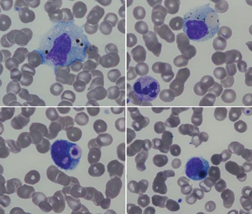 A 46-year-old man with stable HIV and hepatitis C virus chronic infection was seen for unexplained fever, headache, and vomiting after a trip to Cameroon. There were no significant physical findings. Complete blood count showed marked thrombocytopenia (28 × 109/L) and normal white blood cell count and hemoglobin. / Examination of the peripheral blood smear showed severe Plasmodium falciparum infection (parasitemia 1% and 1 schizont). In addition, there were numerous examples of hemophagocytosis on the peripheral blood smear. The top left panel shows a monocyte with particulate debris, perhaps remnants of the malarial infection. The top right panel shows a red cell engulfed by a monocyte. On the bottom left, the phagocytosed material resembles a platelet, and on the bottom right is a larger, circular, phagocytosed object that may represent an erythroblast nucleus or a giant platelet. Additional laboratory tests included triglycerides 5.29mM, ferritin 897 μg/L, and lactic dehydrogenase 278 UI/L, adding support for the hemophagocytic syndrome. After receiving intravenous quinine, he rapidly improved with correction of thrombocytopenia. / Hemophagocytic syndrome is a life-threatening disease associated with excessive stimulation of tissue macrophages. It has been noted in lymphoma, infections, or autoimmune diseases. Hemophagocytic syndrome with malaria infection has been described but without the demonstration of hemophagocytosis in the peripheral blood.