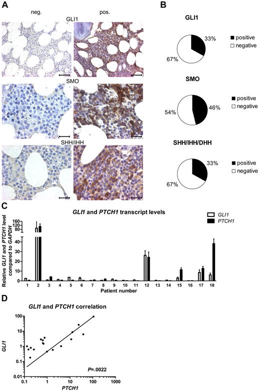 Figure 1. The activation status of HH signaling is highly diverse in CLL. (A) IHC stainings from CLL BM samples for GLI1, SMO, and the HH ligands SHH/IHH. Negative (left) and positive (right) examples for expression of GLI1, SMO, and the HH ligands in CLL. Original magnification ×40 for GLI1 (scale bar, 50 μm) and ×100 for others (scale bar, 25 μm). Microscope: Axioplan 2 (Zeiss); GLI1 40×/0.95 NA; SMO + SHH/IHH 100×/1.25 NA oil objective, room temperature; microscope software: AxioVision LE. (B) Percentage of samples positive or negative for IHC staining for GLI1, SMO, and the HH ligands SHH/IHH and DHH in 24 CLL cases (single patient information, including scoring; supplemental Table 3). (C) qPCR for GLI1 and PTCH1 in peripheral blood samples from patients with CLL. Transcript levels are shown relative to GAPDH and compared with the median of all samples (patient single data; supplemental Table 4). (D) Correlation in between GLI1 and PTCH1 transcript levels in same patients with CLL as in panel C shows a positive correlation between both genes (n = 18; P = .0022, Spearman correlation coefficient, r = 0.67321).