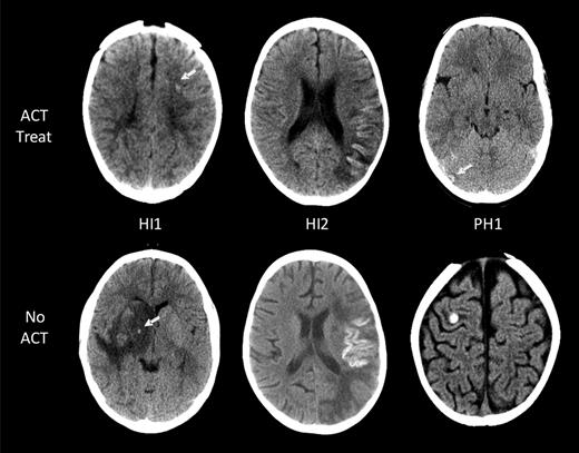 Figure 2. ICH in children with AIS. Intracranial hemorrhages are classified according to the ECASS grading system. Representative examples of the 3 grades encountered (HI1, HI2, and PH1) are shown for both children on ACT (top row) and those not on ACT (bottom row). No larger hematomas or ECASS PH2 were observed in the ACT-treated group. White arrows point at areas of ICH.