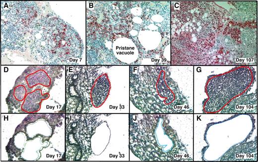 Figure 1. LMD isolates PCs undergoing tumor progression in inflammatory peritoneal granulomas. (A-C) Low-power images (originally using 10× objective) of peritoneal OGs containing PCs analyzed at early (day 7), middle (day 39), and late (day 107) times after IP injection of 0.5 mL of pristane oil. Paraffin-embedded formalin-fixed tissues were sectioned and stained with Ab against mouse Ig κ light chains to identify PCs (red), and then counterstained with hematoxylin to identify stromal cells (blue). (D-K) Microscopic images of MGP-stained frozen sections of pristane granulomas at early (day 17), middle (days 33 and 46), and late (day 104) times after IP pristane before (D-G) and after (H-K) collection of PCs using LMD. The contours of the tissue fragments targeted by the laser beam are indicated by red lines in panels D through G. The actual tissue fragments collected by LMD came from the holes seen in panels H through K. Microscopic slides were read using an Olympus BX-51 Light Microscope equipped with UPLSAPO objectives (Olympus) of the following magnifications and numerical apertures: 10×, 0.4 (panels A-C); 20×, 0.75 (panels D,H,F,J); 40×, 0.95 (panels E,I,G,K). The imaging medium was air. The light temperature of the microscope bulb varied between 3000 and 3400 K. Images were acquired with the help of a DP2 digital camera (Olympus) and DP2-BSW imaging software (Olympus), saved as TIF (tagged image file) data files, and enhanced—with respect to brightness, contrast, and color balance—using the Adobe Photoshop CS2 Version 9.0.2 software (Adobe Systems Inc).