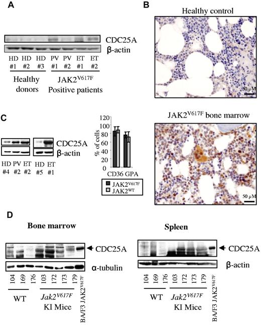 Figure 2. CDC25A is overexpressed in JAK2V617F-positive primary cells. (A) CDC25A expression was analyzed by Western blot in CD36+ cells purified from the BM of 4 JAK2V617F-positive patients (PV, ET) and 3 healthy donors (HD). (B) Paraffin-embedded BM biopsies from 3 JAK2V617F-positive PV patients, 1 JAK2V617F-positive ET patient, and 2 HDs were subjected to an immunohistochemical staining for CDC25A. Pictures representative of JAK2V617F-positive and control BM biopsies are shown. (C) Purified CD34+ cells from a JAK2V617F-positive PV patient, 2 JAK2V617F-positive ET patients, and 2 representative healthy controls (HD) were grown in liquid erythroid differentiation medium. Cells were harvested at day 7, corresponding to a proerythroblast stage, and subjected to a Western blot analysis for CDC25A (left). The presence of CD36 and GPA markers was visualized by flow cytometry (right). (D) BM (left) and spleen lysates (right) from 3 WT and 4 Jak2V617F KI mice were subjected to Western blot analysis for CDC25A. CDC25A expression in BA/F3 JAK2V617F cell line was used as molecular weight control. β-actin or α-tubulin levels were used as control.