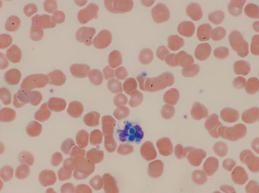 A 17-year-old male with short gut syndrome secondary to Hirschprung disease presented with a 2-week history of night sweats. He had an indwelling central line for total parental nutrition (TPN) supplementation and a history of multiple line infections with a variety of organisms. After completing a 10-day course of prophylactic fluconazole, and 1 week before the onset of night sweats, he had 4 teeth extracted. / Complete blood count showed a leukocyte count of 4.0 × 103/mL (73% neutrophils) and the peripheral blood smear revealed neutrophils with brilliant blue–colored yeast-like intraleukocytic organisms, 2 to 4 μm in diameter (see figure, Wright-Giemsa). The organisms had neither the pseudocapsule or eccentric chromatin suggestive of Histoplasma capsulatum; nor did they produce the “collarettes” indicative of the phialides of Malassezia furfur, a lipid-dependent yeast associated with fungemia in patients requiring TPN. Subsequently, blood cultures grew Candida glabrata. The isolate had a minimum inhibitory concentration of 16 μg/mL to fluconazole and 0.015 μg/mL to micafungin. Anidulafungin therapy was initiated and the infection cleared. / Candida glabrata is a commensal yeast of the gastrointestinal tract and mucocutaneous membranes of humans. It may cause bloodstream infections, especially in immunocompromised individuals or in those with indwelling lines.