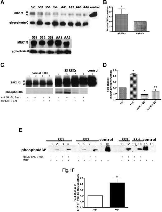 Figure 1. ERK undergoes activation in SS but not normal RBCs. (A-B) Fifty micrograms of membrane protein ghosts (SS RBC ghosts, n = 4, lanes: SS1, SS2, SS3, and SS4; and normal RBC ghosts, n = 4, lanes: AA1, AA2, AA3, and AA4) were used per lane. Western blots of protein ghosts were stained with antibodies against ERK1/2, glycophorin C as a loading control, and MEK1/2 (n = 3 for SS RBC ghosts, lanes: SS1, SS2, and SS3; and n = 2 for normal RBC ghosts, lanes: AA1 and AA2). (A) ERK1/2 and MEK1/2 are highly expressed in both SS and normal RBCs and are bound to the RBC plasma membrane. (B) Quantitative analysis of the data (normalized according to glycophorin C expression) presented as relative ERK1/2 expression compared with normal RBCs (P < .05 for SS vs normal RBCs, n = 4 for each). (C-D) Normal RBCs (n = 3, lanes: 1, 2, 3, and 4) and SS RBCs (n = 3, lanes: 5, 6, 7, and 8) were sham-treated (lanes 1 and 5), incubated for 1 minute with 20nM epinephrine (epi; lanes 2 and 6), pretreated with the MEKI, U0126, followed by epi treatment (lanes 4 and 8), or treated with U0126 alone (lanes 3 and 7). Mouse 3T3/A31 fibroblast lysate was used as a positive control (lane 9). One hundred micrograms of SS and normal RBC ghost proteins were used per lane. Western blots were stained with antibodies against ERK and phosphoERK. (C) ERK1/2 is phosphorylated at baseline in SS RBCs and undergoes increased phosphorylation by epi stimulation. ERK in normal RBCs was not phosphorylated and completely failed to undergo increased phosphorylation after epi stimulation. (D) Quantitative analysis of the data is presented as fold change in ERK phosphorylation. *P < .01 compared with untreated cells. **P < .001 compared with epi-treated SS RBCs. (E-F) ERK immunoprecipitated from sham-treated (lanes: 1, 2, 5, and 6) and epi-treated (lanes: 3, 4, 7, 8, 11, 12, 13, and 14) SS RBCs was incubated without MBP (lanes: 1, 3, 5, 7, 11 and 13) or with MBP (lanes: 2, 4, 6, 8, 12, and 14) as a substrate for ERK, with equal protein amounts per assay condition. Commercial active recombinant human ERK2 was incubated without MBP (lanes: 9 and 16) or with MBP (lanes: 10 and 15) as negative and positive controls, respectively. (E) Immunoblots indicate that the activity of ERK is conserved and functional in SS RBCs and epi can intensify its activity. SS RBCs obtained from 4 different patients (SS1, SS2, SS3, and SS4) were tested. (F) Quantitative analysis of the data are presented as fold change in ERK phosphorylation (n = 4). *P = .0286 compared with nontreated cells.