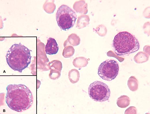 A 55-year-old woman being worked up for possible bladder prolapse was found to have pancytopenia. She had no prior history of malignancies or exposure to chemotherapy or radiation. Her CBC showed WBC 1.0 × 109/L, neutrophils 0.14 × 109/L, hemoglobin 99 g/L, MCV 100 fL, and platelet count 61 × 109/L. A peripheral blood smear confirmed the pancytopenia and bone marrow aspirate revealed numerous medium to large monomorphic blast cells (40%) with basophilic cytoplasm containing vacuoles (panel A). Several of these blast cells had an immature folded-in nucleus with nucleoli and vacuolation (panel B). Flow cytometric analysis demonstrated a population of cells positive for CD34, CD117, CD13, CD33, human leukocyte Ag-DR, CD15, and MPO positive consistent with a myeloblast population. Cytogenetic studies revealed a complex karyotype with the presence of trisomies 8 and 21 and deletion 17p. The patient was admitted to the hospital and started on standard induction chemotherapy with cytarabine and daunorubicin for acute nonlymphocytic leukemia. / Acute leukemia should be considered in a patient with pancytopenia and a peripheral blood smear can sometimes provide clues. It was not until a bone marrow aspirate was performed that demonstrated the presence of pleomorphic myeloblasts, particularly monoblasts, that the diagnosis was established. Furthermore, flow cytometric analysis and immunohistochemistry are essential to identify the proper induction therapy.