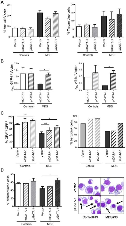 Figure 3. Retroviral μGATA-1 expression rescues MDS erythroid differentiation. MDS (n = 5) and controls (n = 2) progenitors are transduced with empty, wtGATA-1, or μGATA-1 vectors and analyzed at day 14. (A) Apoptosis and cell mortality. Flow cytometry for apoptosis with annexin V (left panel) and mortality as Trypan blue+ cells (right panel). (B) Quantification of GYPA and HBB transcripts. RT-qPCR in MDS (n = 3) and controls (n = 2) erythroblasts normalized to HPRT. Ratios of mean normalized relative quantity ± SE between wtGATA-1 and μGATA-1–transduced cells to empty vector-transduced cells. (C) GPA expression and hemoglobin synthesis. GPA expression (left panel) expressed as mean percentages ± SE of GFP+ cells. Benzidin labeling (right panel) for hemoglobin synthesis measurement as percentages of positive cells. (D) Erythroblast differentiation. Percentage of differentiated polychromatophilic and acidophilic erythroblasts on MGG-stained cytospins (right panel; *P < .05). Representative microphotographs are shown.