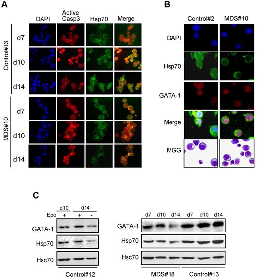 Figure 5. Hsp70 does not colocalize with active caspase-3 or GATA-1 in the nucleus of MDS erythroblasts. Erythroblasts from MDS (n = 7) and controls (n = 4) harvested at day 14. (A) Immunolocalization of Hsp70 and active caspase-3. DAPI for nuclei. Merge represents both active caspase-3 (red) and Hsp70 (green). (B) Immunolocalization of GATA-1 and Hsp70 in polychromatophilic erythroblasts. GATA-1 (red), Hsp70 (green), and DAPI (blue). Merge represents the superimposition of all 3 colors. (C) Expression of GATA-1 and Hsp70 in MDS erythroblast nuclei. MDS or control cells are harvested at day 7, 10, and 14. Immunoblot for GATA-1 or Hsp70 in the nuclear fraction. Hsc70 as loading control. Representative experiments are shown.