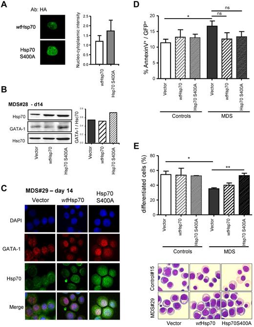 Figure 7. Mutant S400A of Hsp70 rescues MDS erythroblast differentiation. (A) Hsp70 S400A preferentially localizes to the nucleus. Normal erythroblasts transfected with HA-wtHsp70 or HA-Hsp70 S400A plasmids. Immunofluorescence anti-HA analyzed by confocal microscopy. (B) Immunoblot analysis of Hsp70 and GATA-1 expression. MDS erythroblasts infected with wtHsp70 or Hsp70 S400A or empty lentiviral vector at day 14. (Top panel) Representative immunoblot. (Bottom panel) Quantification of GATA-1 normalized to Hsc70 by densitometry. (C) Immunofluorescence for Hsp70 and GATA-1 in day 14 erythroblasts. MDS (n = 9) or control (n = 4) erythroblasts were infected with wtHsp70 or Hsp70 S400A or empty lentiviral vector. Nuclei countercolored with DAPI. (D) Apoptosis. Annexin V labeling in the GFP+ cells. (E) Erythroid differentiation. Differentiated polychromatophilic and acidophilic erythroblasts numbered on MGG-stained cytospins. Representative microphotographs are shown. Student t test for P values; *P < .05; **P < .01; ns indicates not significant.