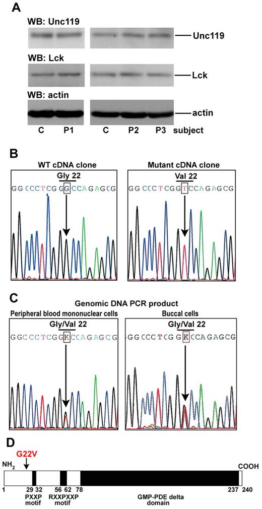Figure 2. Heterozygous missense mutation of Unc119 at glycine 22 in an ICL patient 1 (P1). (A) Western blot analysis of CD4 T-cell lysates. CD4 T cells from subjects as in Figure 1 were lysed and blotted with anti-Unc119, anti-Lck, and anti-actin Abs. Each blot represents one of 3 independent experiments. (B) Sequence of cDNA clones. RNA from PBMCs obtained from P1 was reverse transcribed. Unc119 cDNA was amplified by PCR, cloned, and sequenced. Wild-type (WT) and mutant clones were identified. The G to T transversion in codon 22 resulted in a glycine (Gly) to valine (Val) substitution. (C) Sequence of the genomic DNA PCR products. Genomic DNA was isolated from P1 PBMCs (left panel) and from the P1 buccal swab sample (right panel). The Unc119 exons were amplified and the PCR products were sequenced. The figure shows select sequence from the exon 1 PCR product. In the sequence, a single peak of G overlapped with that of T at codon 22. The sequencer read these overlapping peaks as an unidentified base K. (D) Schematic representation of the Unc119 protein structure. The position of the G22V mutation in P1 is marked with an arrow. GMP-PDE δ domain, the cyclic guanosine monophosphate phosphodiesterase δ domain