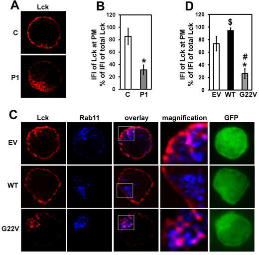 Figure 4. Effect of Unc119 G22V on Lck localization. (A) Peripheral blood CD4 T cells from P1 and a healthy control subject (C) were immunostained for Lck (red) and inspected with a fluorescent microscope (magnification ×1000). Z-stacks of images were collected and subjected to three-dimensional (3D) deconvolution using the measured point spread function (PSF) method. A representative plane is shown. (B) The relative amount of Lck at the plasma membrane of cells from panel A was quantified. Deconvolved z-stacks from 15 cells obtained from 3 separate experiments were used for fluorescent intensity measurements as described in “Methods.” The integrated fluorescent intensity (IFI) of Lck at the plasma membrane (PM) was expressed as a percentage (mean ± SD) of the IFI of the entire cellular Lck. *P < .05 (Mann-Whitney U test). (C) Normal CD4 T cells were infected and sorted as in Figure 3A. Cells were immunostained for Lck (red) and Rab11 (blue). Z-stacks of green (GFP), red, and blue fluorescence were collected. Z-stacks of red and blue fluorescence were subjected to 3D deconvolution as in panel A. The boxed area in the overlay image is magnified and displayed to the right of the image. Pink areas in cells denote colocalization of red Lck and blue Rab11. (D) Deconvolved Z-stacks of Lck fluorescence from panel C were quantified as in panel B. Images of 15 cells from 3 experiments (each experiment done using blood from a different healthy donor) were measured. P < .05 (Mann-Whitney U test) for difference between G22V and EV cells (*), G22V and WT cells (#), and WT and EV cells ($).