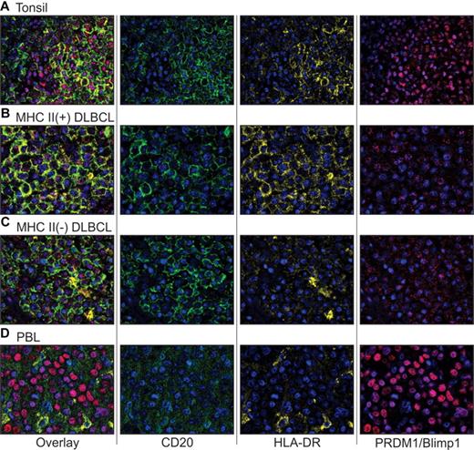 Figure 2. Quantum dot IHC for expression of CD20, MHC II (HLA-DR), and PRDM1/Blimp1 in tonsil, DLBCL, and PBL. (A) Tonsil control. (B) MHC II(+) DLBCL. (C) MHC II(−) DLBCL. (D) PBL. Multiplexed quantum dot IHC was performed as described in “Quantum dot fluorescent IHC.” Images (original magnification ×40) demonstrate the composite wavelength image (overlay), followed by 2-color overlays of the unmixed spectral components (CD20, HLA-DR, and PRDM1/Blimp1) depicting individual quantum dot analytes and nuclear counterstain (DAPI). It should be noted that the imaging software artificially increases intensity to match the dynamic range of the display, so that some proteins scored as negative by eye demonstrate an artifactual dusting in the overlay images. For detailed methods on image acquisition, please see supplemental Methods (available on the Blood Web site; see the Supplemental Materials link at the top of the online article).