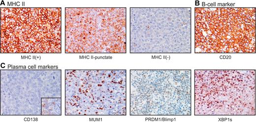 Figure 4. Expression of MHC II, B-cell markers, and plasma cell markers in DLBCL. Chromogenic IHC was performed as described in “Chromogenic IHC” to visualize proteins as marked. Original magnification ×40. The full range of expression (intensity and percentage of positive cells) varied for each protein; images selected show the upper range of expression for that marker. (A) MHCII marker HLA-DR. (B) B-cell marker CD20, and (C) plasma-cell markers CD138, MUMI, PRDM1/Blimp1, XBP1s. Inset: positive staining for CD138 in tonsil control.