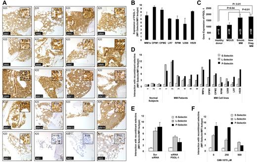 Figure 1. PSGL-1 is highly expressed on MM cells and regulates interaction with P-selectins. (A) Expression of PSGL-1 detected in BM biopsies from MM patients (n = 17) and healthy individuals (n = 3) using immunohistochemistry. Images are showing 20× magnification and inserts are showing 100× magnification. All MM patients presented with a higher expression of PSGL-1 compared with healthy individuals. (B) Expression of PSGL-1 evaluated on MM cell lines (MM.1S, OPM1, OPM2, LR7, RPMI.8226, U266, and H929) using flow cytometry and expressed as a ratio between the MFI of PSGL-1 and the MFI of the isotype control. (C) Gene-expression profiling of PSGL-1 from available dataset series number GSE 6477. The expression level of PSGL-1 significantly increases with MM tumor progression from MGUS to smoldering MM to newly diagnosed MM. Significant differences are observed between healthy subjects and MM patients (both smoldering MM and newly diagnosed MM) (P < .01). (D) CD138+ cells isolated from either normal BM (n = 3) or MM BM (n = 6) and MM cell lines (MM.1S, OPM1, OPM2, RPMI.8226, U266, LR7, and H929) incubated with free human Fc-chain (isotype control) or with chimeras of human-Fc chain and recombinant human E-, L-, or P-selectin (10 μg/mL) for 1 hour, followed by FITC-conjugated mouse anti–human Fc. The interaction of the selectins with MM cells was analyzed by flow cytometry and quantified as the ratio of the MFI of each selectin to the MFI of the isotype control. P- and L-selectins (but not E-selectin) interacted with MM primary cells and cell lines, whereas none of the selectins interacted with the normal plasma cells. (E) MM1s cells were transfected with either PSGL-1 siRNA or scramble siRNA. Cells were exposed to recombinant human E-, L-, and P-selectin (10 μg/mL) for 1 hour. The interaction of selectins with MM cells was analyzed by flow cytometry and quantified as ratio of MFI of each selectin to the MFI of the isotype control. Down-regulation of PSGL-1 reduced the interaction of both L- and P-selectins with MM cells. (F) MM.1S cells were treated with increasing concentrations of GMI-1070 (0, 250, and 500μM) for 1 hour and then exposed to recombinant E-, L-, and P-selectin (10 μg/mL, for 1 hour). The interaction of selectins with MM cells was analyzed by flow cytometry and quantified as a ratio of MFI of each selectin to the MFI of the isotype control. Dose-dependent inhibition of the interaction of L- and P-selectins was observed. All data represent means ± SD of triplicate experiments.