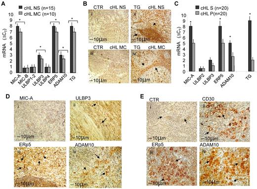 Figure 1. NKG2D-L, ERp5, and ADAM10 expression in cHL. Twenty-five cHLs were studied. (A) Quantitative RT-PCR for MIC-A/B, ULBP1 to ULBP4, TG, ERp5, and ADAM10 was performed with the specific primers and probes on RNA extracted from the whole LN sections (8 μm). After subtracting the Ct value for RPLP0 from the Ct values of the target genes, results were expressed as ΔCt. Data are the mean ± SD from 15 NS samples (black columns) and 10 MC samples (gray columns). *P < .001 versus healthy LN (supplemental Figure 1A). (B) TG staining on NS (Bii) or MC (Biv) cHL sections (4 μm) One representative staining of 20 (11 NS and 9 MC). (Bi,iii) Negative control (CTR) on NS or MC serial sections, respectively. (C) Quantitative RT-PCR of stromal (S) or parenchymal (P) microdissected areas of serial sections (n = 20 cHL: 11 NS and 9 MC) that underwent LCM on the basis of the localization of TG. Quantitative RT-PCR for MIC-A/B, ULBP2, ULBP3, TG, ERp5, and ADAM10 was performed as in panel A, normalized for RPLP0, and results calculated as ΔCt. Data are the mean ± SD from 10 S and 10 P areas cut from 20 cHL. *P < .001 S versus parenchymal. (D-E) Immunostaining for MIC-A (Di), ULBP3 (Dii), ERp5 (Diii,Eiii) ADAM10 (Div,Eiv), and CD30 (Dii) on LN sections from a representative NS (D) or MC (E) cHL of 11 NS and 9 MC analyzed. Arrows indicate positive areas. (Ei) Negative control. Arrows in panel E indicates RS cells. The slides were analyzed under an IX70 microscope (Olympus Biosystem) equipped with a camera (Camedia 4040Zoom, Olympus; original magnification ×200 with a 20×/0.50 NA objective). Black bar represents 10 μm.