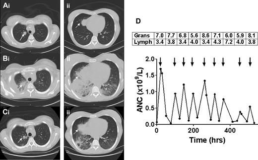Figure 1. Sequential CT scans of the thorax and response to granulocyte transfusions. CT scan before granulocyte transfusions showed nodules in the right upper lobe (Ai, solid arrow, 2 cm) and right middle lobe (Aii, dotted arrow, 3.5 cm). CT after 4 transfusions of granulocytes revealed a new right pleural effusion, new right lower and middle lobe consolidation, and left lower lobe airspace disease, and enlargement of existing nodules (Bi-ii). CT after 5 additional granulocyte transfusions showed marked improvement in lung consolidations, accompanied by clinical resolution of fever, tachypnea, and hypoxia (Ci-ii). The granulocyte (× 1010) and lymphocyte (× 109) content of each of the 9 transfused granulocyte components (arrows) is shown in the boxes above the arrows, with the corresponding increment in ANC shown below the arrows (D). Mean granulocyte content was 6.9 × 1010 cells per product.