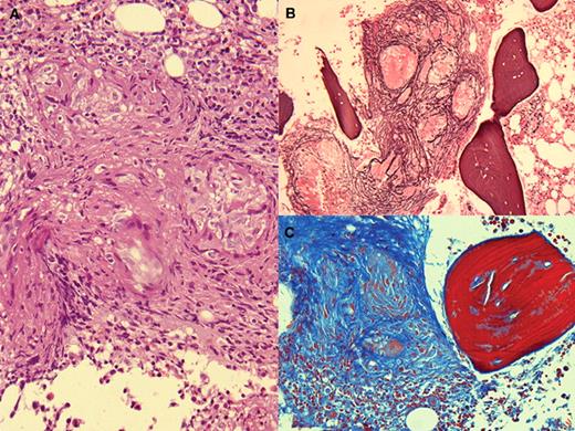 A 44-year-old woman was evaluated for a 2-month history of asthenia, weight loss, and nightly fever. She had no hepatosplenomegaly or adenopathy. The complete blood count and the basic chemistries were normal as were the radiologic examinations of the chest and abdomen. Cultures of blood and urine and serologic studies for rickettsia, chlamydia, brucella, Legionella, and Mycoplasma were negative. Sputum for Mycobacteria was negative. Bone marrow aspirate showed no abnormalities of marrow elements but noncaseating granulomata were observed in the H&E stain of the biopsy (panel A). In addition, the silver nitrate stain (panel B) and Masson trichrome (panel C) showed fibrosis. The acid-fast stain and marrow cultures were negative. Angiotensin-1 converting enzyme was shown to be elevated (119 UI/L). / A diagnosis of sarcoidosis was suggested based on the marrow, clinical findings, and the elevation of angiotensin-1 converting enzyme. Adalimumab was initiated and the patient improved with the disappearance of constitutional symptoms and fever. A follow-up bone marrow has not yet been performed. / Bone marrow granulomata are often found without well-defined causes. Sarcoid granulomata are infrequent, perhaps related to the fact that bone marrow studies are not routine investigation for sarcoidosis.