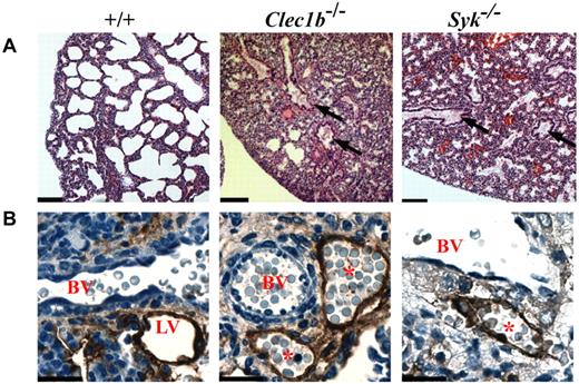 Figure 2. Lungs of P0 Clec1b−/− and Syk−/− mice have a similar pathology. (A) Representative low magnification (10×) photomicrographs of H&E-stained paraffin sections from P0 lung showed detail of the lung's contribution to the lethal phenotype of the Clec1b−/− and Syk−/− mice (n ≥ 3 for each genotype). Lungs from P0 wild-type (+/+) mice showed large open bronchi and expanded terminal air sacs with thin septae between airspaces. In contrast, lungs from Clec1b−/− and Syk−/− mice showed fluid accumulation in the bronchi (black arrows) as well as incompletely expanded terminal airways. Scale bar = 100 μm. (B) Lymphatic vessels (LVs) localized next to blood vessels (BVs) were identified with an Ab to podoplanin (brown staining). These vessels were clear in Clec1b+/+ and Syk+/+ (+/+) mice but contained red blood cells in Clec1b−/− and Syk−/− mice, indicating a connection between the lymphatic and circulatory systems. Scale bar = 20 μm.