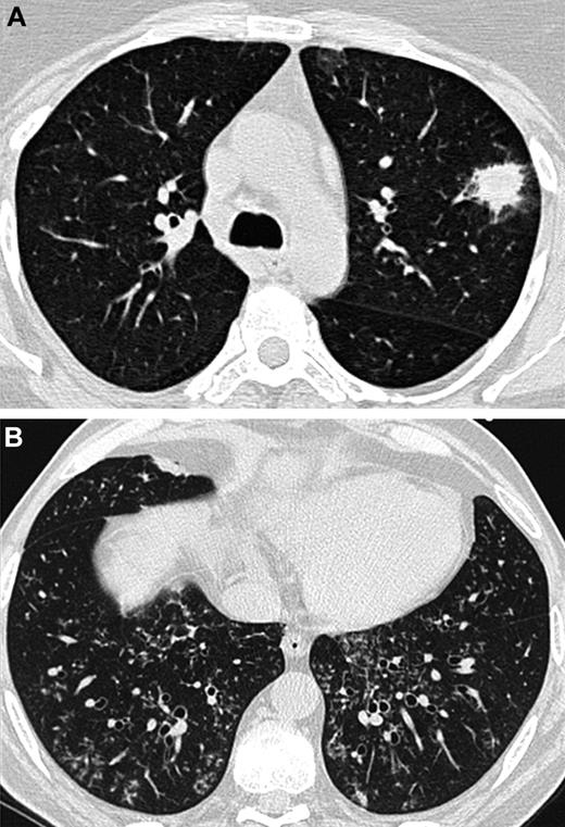 Figure 1. Lung CT scans from 2 different patients. (A) Nodule with a halo sign revealing angioinvasive aspergillosis in an AL patient. (B) Centrilobular nodules and tree-in-bud opacities showing airway-invasive aspergillosis in a patient who underwent an allogeneic HSCT.